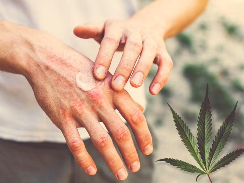 Luskavica in konoplja